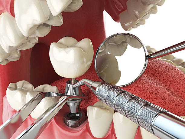 Best Emergency Root Canal Treatment in Port Washington North, NY